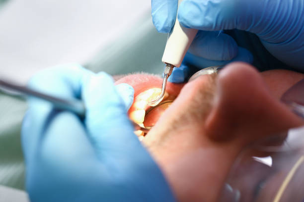 Best Emergency Root Canal Treatment in Edneyville, NC